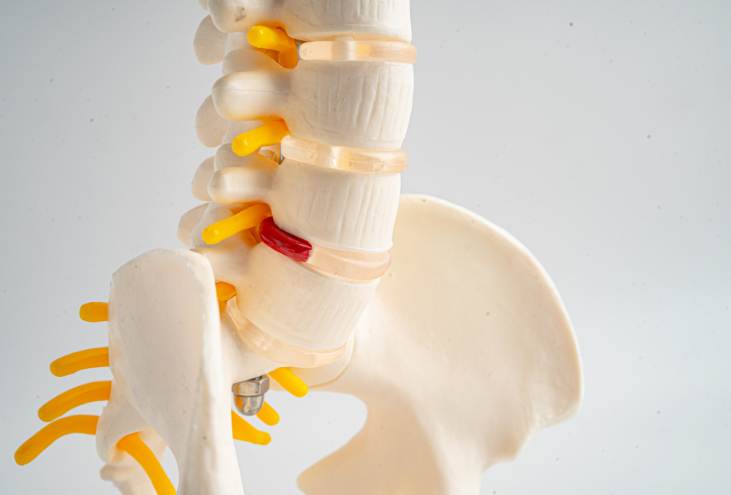 Spinal Stenosis vs. Degenerative Disc Disease: How Doctors Tell the Difference