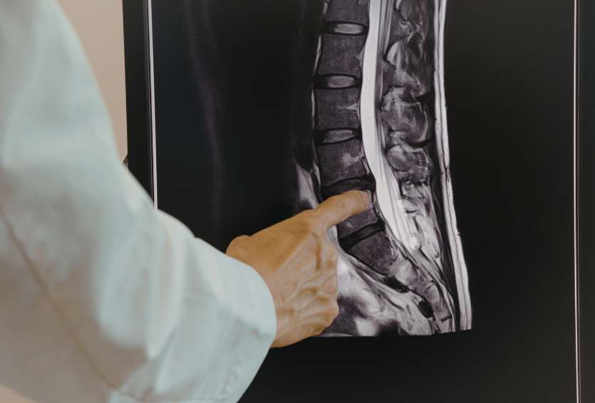 Spinal CSF Leaks: Causes, Symptoms, and Modern Treatment Options