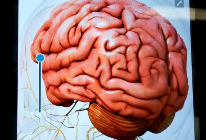 Subdural Hematoma: Causes, Symptoms, and When Surgery Is Needed