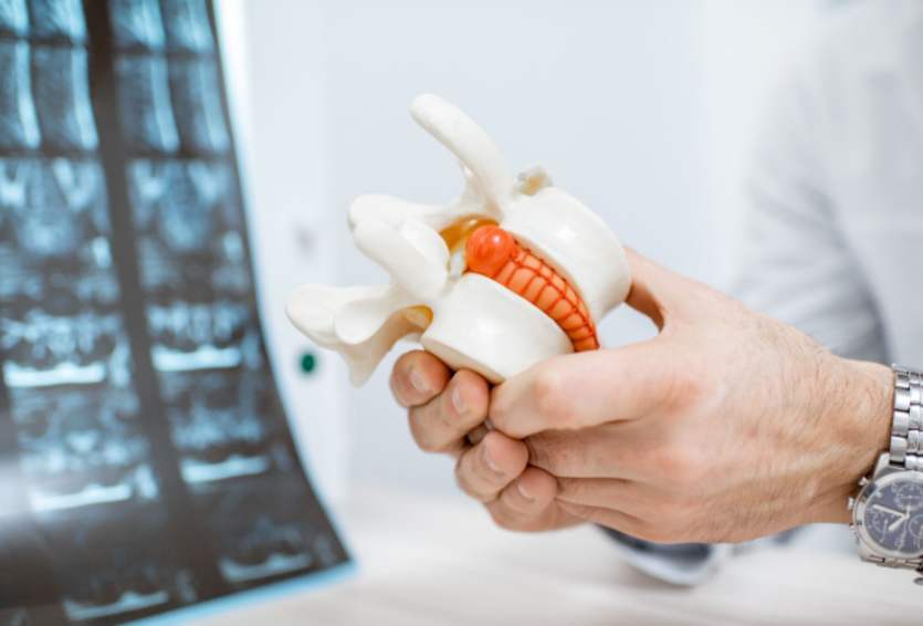 Thoracic Disc Herniation: The Overlooked Cause of Mid-Back Pain