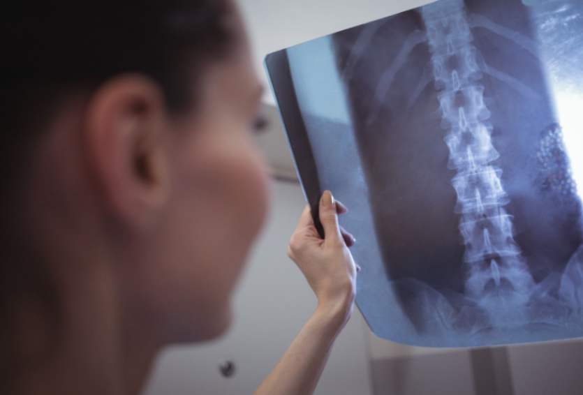 Spinal Fractures: Treatment Options From Bracing to Surgery